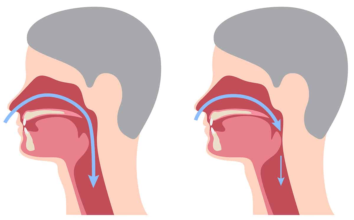 An illustration comparing a normal and a closed airway