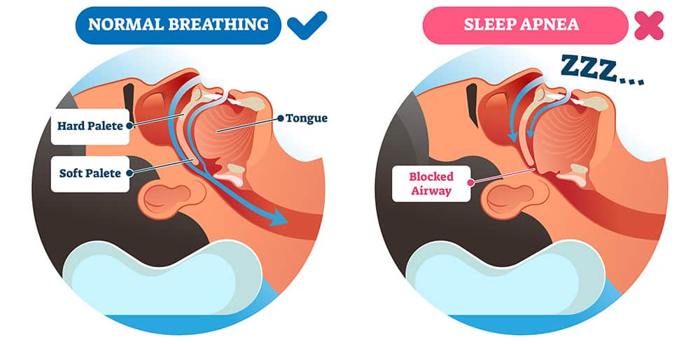 An illustration showing the difference between a normal airway and an obstructed airway that causes sleep apnea