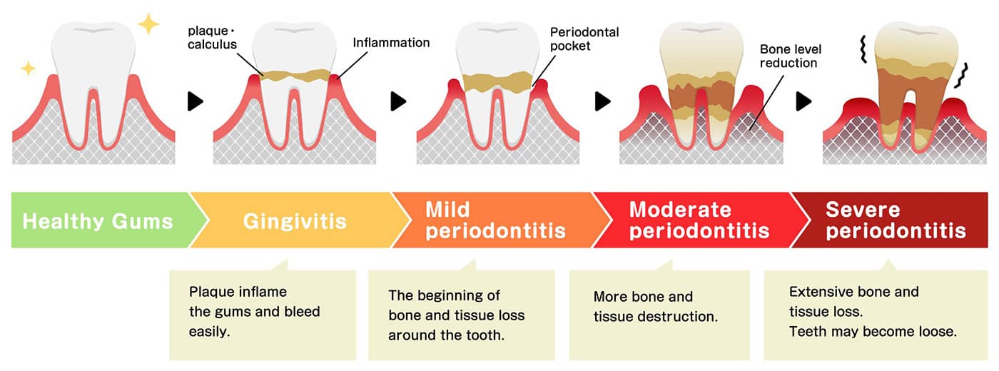 A medical illustration showing the stages of periodontal disease